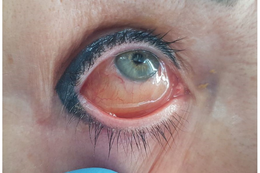 В Чебоксарах девушка после татуажа век получила химический ожог глаз