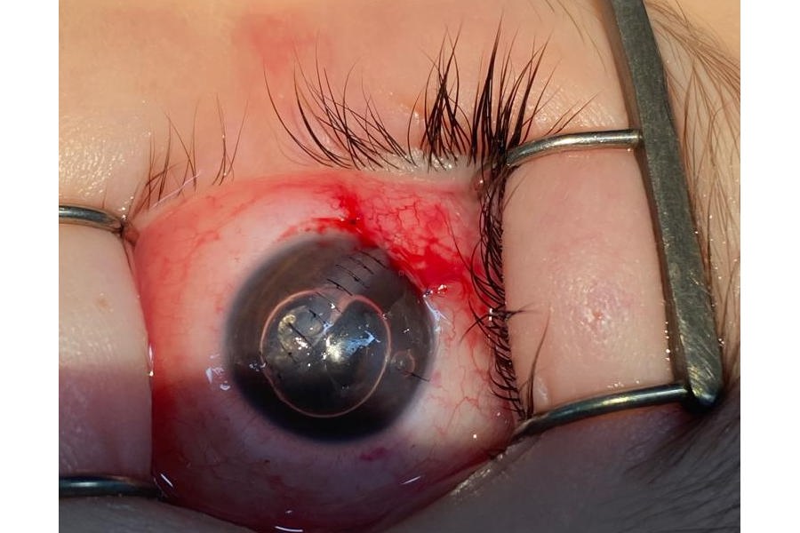 Травмы глаз могут привести к потере зрения - предупреждают врачи-офтальмологи
