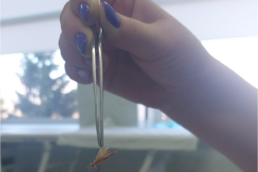 Весна пришла: в Чувашии врачи извлекли из уха парня крупное насекомое