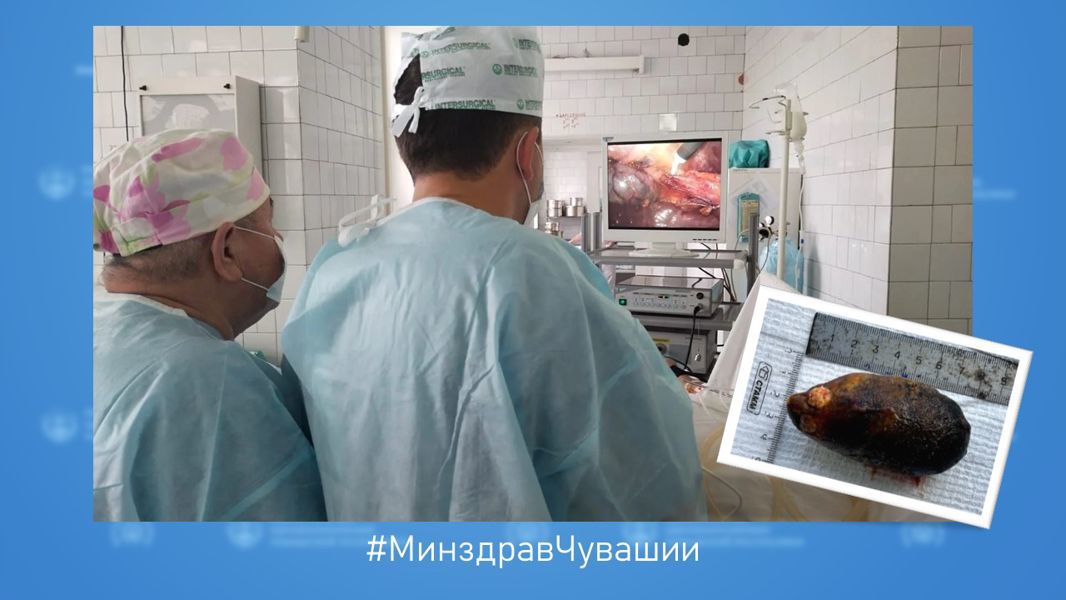 Врачи Цивильской больницы успешно удалили гигантский камень из желчного пузыря пациентки