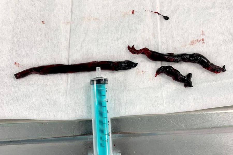 Хирурги извлекли из легочной артерии пациента тромбы длиной более 10 см
