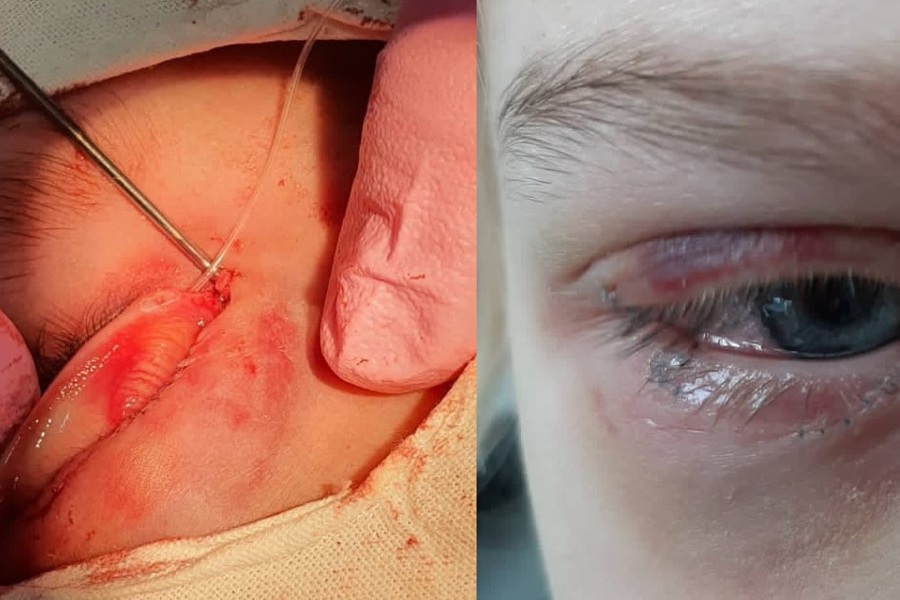 Офтальмологи помогли девочке, которую укусила собака